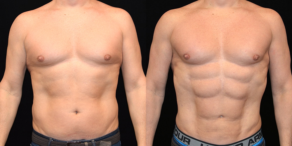 EZ 6Pack Muscle Stimulator Before and After Results